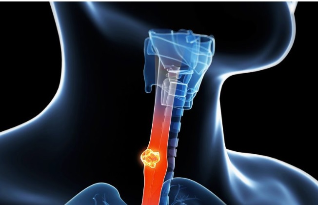 Mas de mil nuevos casos de cáncer de esófago en México